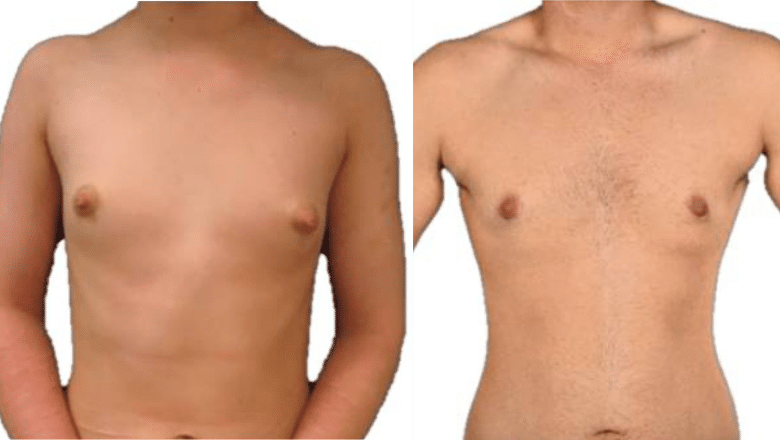 FTM Top Surgery Before and After